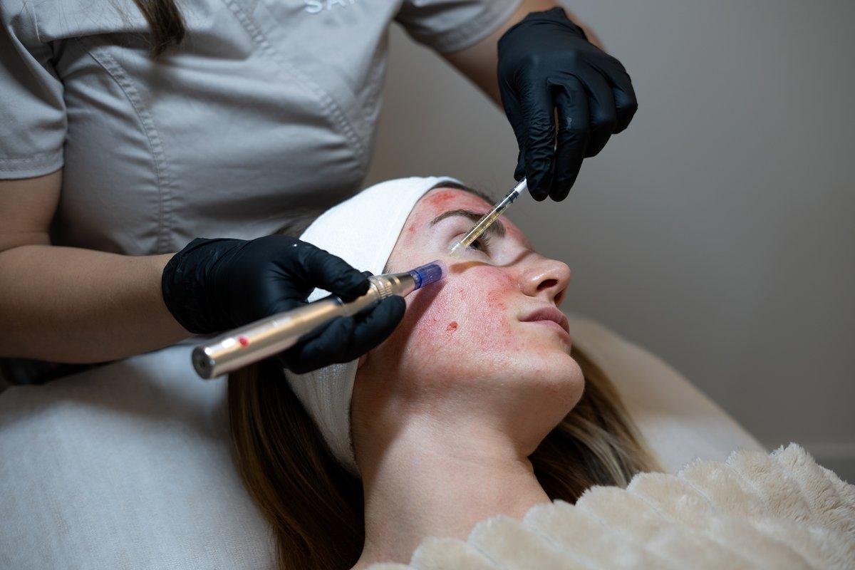 PRP Therapy